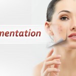 Get rid of pigmentation naturally