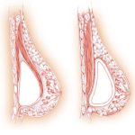 Bounce Back After Pregnancy With Breast Augmentation Bounce Back After Pregnancy With Breast Augmentation