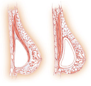 Bounce Back After Pregnancy With Breast Augmentation