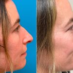 What Fixing a Droopy Nose Entails What Fixing a Droopy Nose Entails